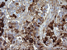 SERPINB3 Antibody - IHC of paraffin-embedded Carcinoma of Human lung tissue using anti-SERPINB3 mouse monoclonal antibody. (Heat-induced epitope retrieval by 10mM citric buffer, pH6.0, 120°C for 3min).