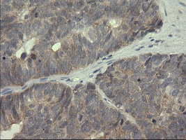 SERPINB3 Antibody - IHC of paraffin-embedded Adenocarcinoma of Human ovary tissue using anti-SERPINB3 mouse monoclonal antibody.