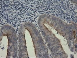 SERPINB3 Antibody - IHC of paraffin-embedded Adenocarcinoma of Human endometrium tissue using anti-SERPINB3 mouse monoclonal antibody.