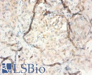 SERPINB3 Antibody - Immunohistochemistry of paraffin-embedded human liver cancer using SERPINB3 / SCC antibody at dilution 1:100.