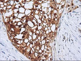 SERPINB4 / SCCA1+2 Antibody - IHC of paraffin-embedded Carcinoma of Human pancreas tissue using anti-SERPINB4 mouse monoclonal antibody.