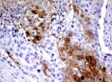 SERPINB4 / SCCA1+2 Antibody - Immunohistochemical staining of paraffin-embedded Carcinoma of lung tissue using anti-SERPINB4mouse monoclonal antibody. (Clone UMAB16, dilution 1:100; heat-induced epitope retrieval by 10mM citric buffer, pH6.0, 120C for 3min)