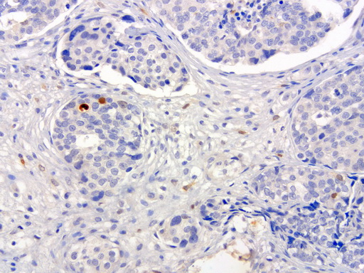 SERPINB4 / SCCA1+2 Antibody - Immunohistochemical staining of paraffin-embedded human ovarian carcinoma using anti-SERPINB4 clone UMAB16 mouse monoclonal antibody  at 1:100 with Polink2 Broad HRP DAB detection kit; heat-induced epitope retrieval with GBI Accel pH8.7 HIER buffer using pressure chamber for 3 minutes at 110C. Cytoplasmic and membrane staining is seen in tumor cells.