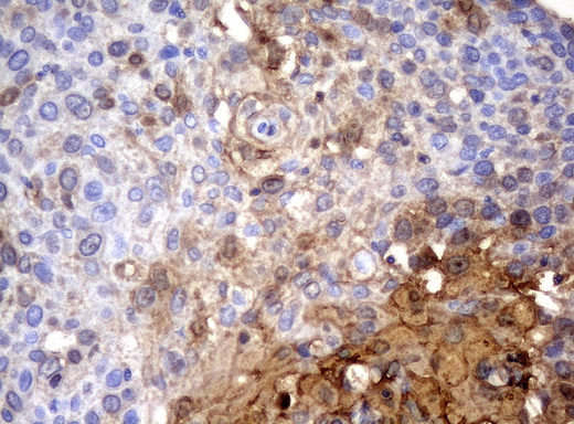 SERPINB4 / SCCA1+2 Antibody - Immunohistochemical staining of paraffin-embedded Carcinoma of bladder tissue using anti-SERPINB4mouse monoclonal antibody. (Clone UMAB16, dilution 1:100; heat-induced epitope retrieval by 10mM citric buffer, pH6.0, 120C for 3min)