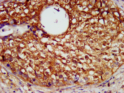 SERPINB4 / SCCA1+2 Antibody - Immunohistochemistry image at a dilution of 1:600 and staining in paraffin-embedded human cervical cancer performed on a Leica BondTM system. After dewaxing and hydration, antigen retrieval was mediated by high pressure in a citrate buffer (pH 6.0) . Section was blocked with 10% normal goat serum 30min at RT. Then primary antibody (1% BSA) was incubated at 4 °C overnight. The primary is detected by a biotinylated secondary antibody and visualized using an HRP conjugated SP system.