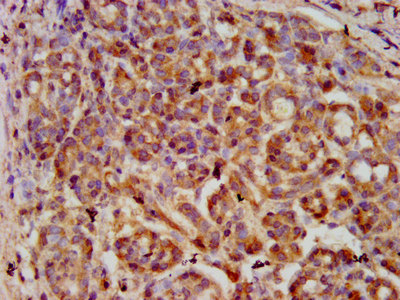SERPINB4 / SCCA1+2 Antibody - Immunohistochemistry image at a dilution of 1:600 and staining in paraffin-embedded human pancreatic cancer performed on a Leica BondTM system. After dewaxing and hydration, antigen retrieval was mediated by high pressure in a citrate buffer (pH 6.0) . Section was blocked with 10% normal goat serum 30min at RT. Then primary antibody (1% BSA) was incubated at 4 °C overnight. The primary is detected by a biotinylated secondary antibody and visualized using an HRP conjugated SP system.