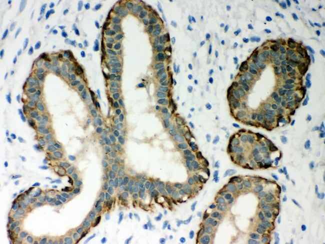 SERPINB5 / Maspin Antibody - MASPIN antibody IHC-paraffin: Human Mammary Cancer Tissue.