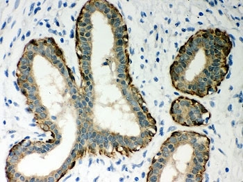 SERPINB5 / Maspin Antibody - IHC-P: SERPINB5 antibody testing of human breast cancer tissue