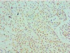 SERPINB5 / Maspin Antibody - Immunohistochemistry of paraffin-embedded human breast cancer using antibody at 1:100 dilution.