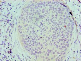 SERPINB5 / Maspin Antibody - Immunohistochemistry of paraffin-embedded human cervical cancer using antibody at 1:100 dilution.