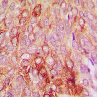 SERPINB5 / Maspin Antibody - Immunohistochemical analysis of Serpin B5 staining in human breast cancer formalin fixed paraffin embedded tissue section. The section was pre-treated using heat mediated antigen retrieval with sodium citrate buffer (pH 6.0). The section was then incubated with the antibody at room temperature and detected using an HRP conjugated compact polymer system. DAB was used as the chromogen. The section was then counterstained with hematoxylin and mounted with DPX.