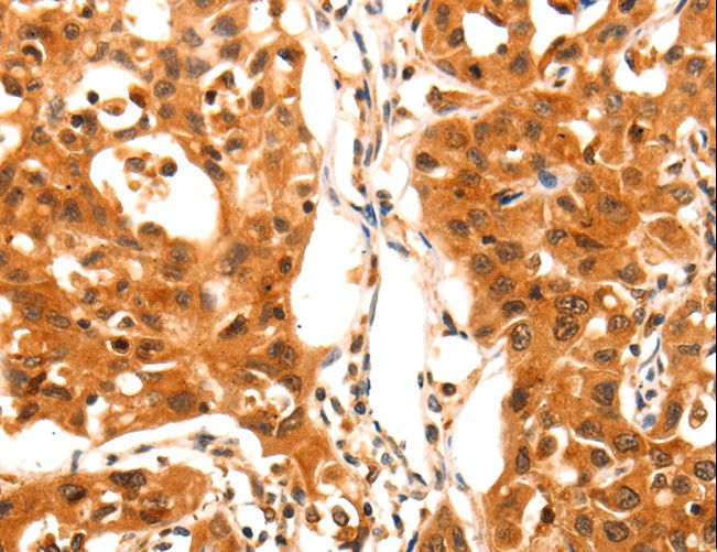 SERPINB5 / Maspin Antibody - Immunohistochemistry of paraffin-embedded Human lung cancer using SERPINB5 Polyclonal Antibody at dilution of 1:60.