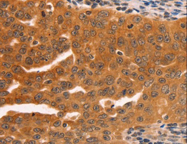 SERPINB5 / Maspin Antibody - Immunohistochemistry of paraffin-embedded Human ovarian cancer using SERPINB5 Polyclonal Antibody at dilution of 1:60.