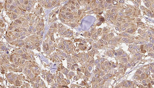 SERPINB5 / Maspin Antibody - 1:100 staining human Melanoma tissue by IHC-P. The sample was formaldehyde fixed and a heat mediated antigen retrieval step in citrate buffer was performed. The sample was then blocked and incubated with the antibody for 1.5 hours at 22°C. An HRP conjugated goat anti-rabbit antibody was used as the secondary.