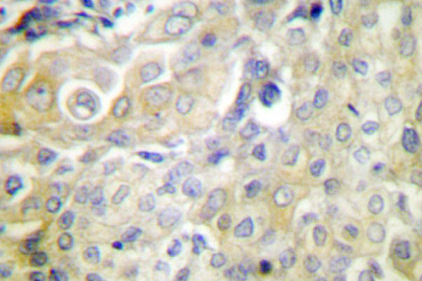 SERPINB5 / Maspin Antibody - IHC of Maspin (T118) pAb in paraffin-embedded human cervix carcinoma tissue.