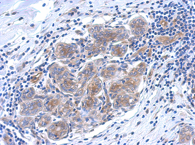 SERPINB6 / PI-6 Antibody - IHC of paraffin-embedded breast ca using SERPINB6 antibody antibody at 1:500 dilution.