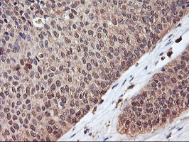 SERPINB6 / PI-6 Antibody - IHC of paraffin-embedded Carcinoma of Human bladder tissue using anti-SERPINB6 mouse monoclonal antibody. (Heat-induced epitope retrieval by 10mM citric buffer, pH6.0, 100C for 10min).