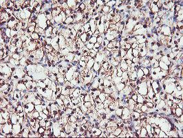 SERPINB6 / PI-6 Antibody - IHC of paraffin-embedded Carcinoma of Human kidney tissue using anti-SERPINB6 mouse monoclonal antibody. (Heat-induced epitope retrieval by 10mM citric buffer, pH6.0, 100C for 10min).
