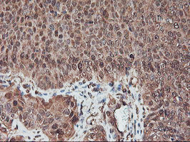 SERPINB6 / PI-6 Antibody - IHC of paraffin-embedded Carcinoma of Human bladder tissue using anti-SERPINB6 mouse monoclonal antibody. (Heat-induced epitope retrieval by 10mM citric buffer, pH6.0, 100C for 10min).