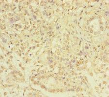 SERPINB6 / PI-6 Antibody - Immunohistochemistry of paraffin-embedded human pancreatic cancer at dilution of 1:100