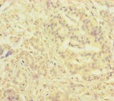 SERPINB6 / PI-6 Antibody - Immunohistochemistry of paraffin-embedded human pancreatic cancer at dilution of 1:100
