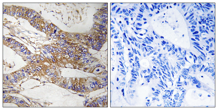 SERPINB9 / PI9 Antibody - Immunohistochemistry analysis of paraffin-embedded human colon carcinoma tissue, using SERPINB9 Antibody. The picture on the right is blocked with the synthesized peptide.