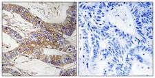 SERPINB9 / PI9 Antibody - Immunohistochemistry analysis of paraffin-embedded human colon carcinoma tissue, using SERPINB9 Antibody. The picture on the right is blocked with the synthesized peptide.