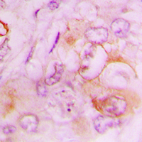 SERPINB9 / PI9 Antibody - Immunohistochemical analysis of Serpin B9 staining in human lung cancer formalin fixed paraffin embedded tissue section. The section was pre-treated using heat mediated antigen retrieval with sodium citrate buffer (pH 6.0). The section was then incubated with the antibody at room temperature and detected using an HRP conjugated compact polymer system. DAB was used as the chromogen. The section was then counterstained with hematoxylin and mounted with DPX.