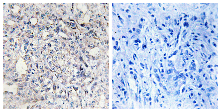 SERPIND1 / Heparin Cofactor 2 Antibody - Immunohistochemistry analysis of paraffin-embedded human liver carcinoma tissue, using Heparin Cofactor II Antibody. The picture on the right is blocked with the synthesized peptide.