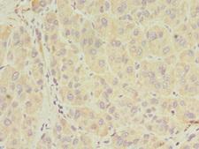 SERPIND1 / Heparin Cofactor 2 Antibody - Immunohistochemistry of paraffin-embedded human liver cancer at dilution 1:100