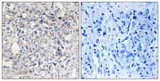 SERPIND1 / Heparin Cofactor 2 Antibody - Peptide - + Immunohistochemistry analysis of paraffin-embedded human liver carcinoma tissue, using Heparin Cofactor II antibody.