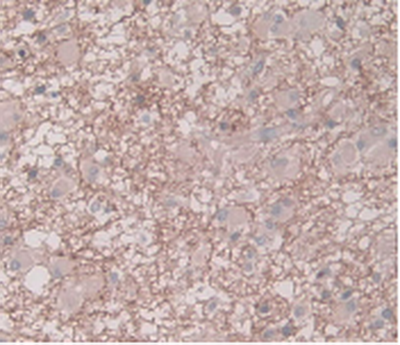 SERPINE1 / PAI-1 Antibody - DAB staining on IHC-P Samples: Human Glioma Tissue