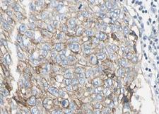 SERPINE1 / PAI-1 Antibody - 1:100 staining human lung carcinoma sections by IHC-P. The tissue was formaldehyde fixed and a heat mediated antigen retrieval step in citrate buffer was performed. The tissue was then blocked and incubated with the antibody for 1.5 hours at 22°C. An HRP conjugated goat anti-rabbit antibody was used as the secondary.