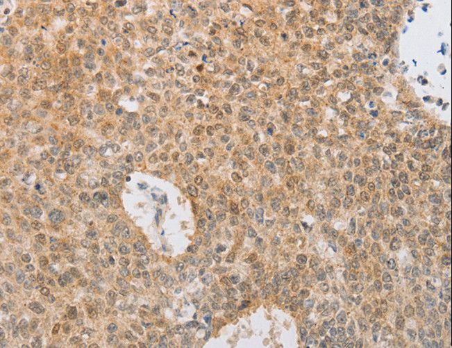 SERPINE2 / Nexin Antibody - Immunohistochemistry of paraffin-embedded Human lung cancer using SERPINE2 Polyclonal Antibody at dilution of 1:20.
