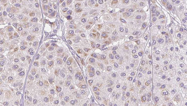 SERPINF1 / PEDF Antibody - 1:100 staining human Melanoma tissue by IHC-P. The sample was formaldehyde fixed and a heat mediated antigen retrieval step in citrate buffer was performed. The sample was then blocked and incubated with the antibody for 1.5 hours at 22°C. An HRP conjugated goat anti-rabbit antibody was used as the secondary.