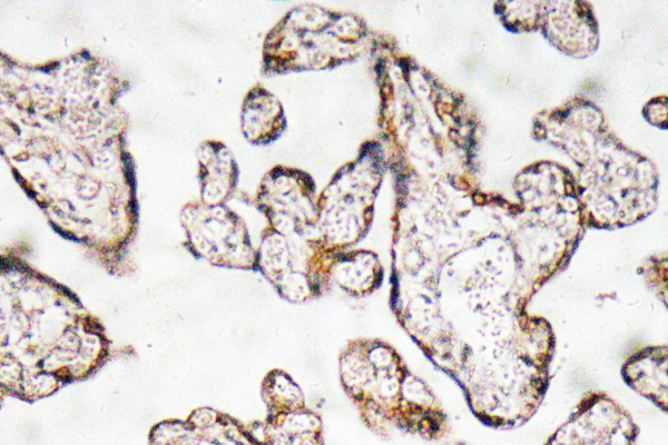 SERPINF1 / PEDF Antibody - IHC of PEDF (T307) pAb in paraffin-embedded human prostate carcinoma tissue.