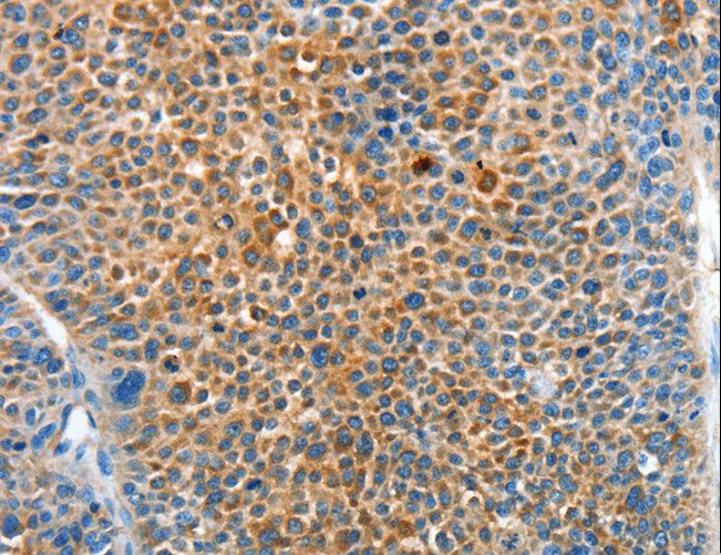 SERPINF2 / Alpha-2-Antiplasmin Antibody - Immunohistochemistry of paraffin-embedded Human liver cancer using SERPINF2 Polyclonal Antibody at dilution of 1:50.