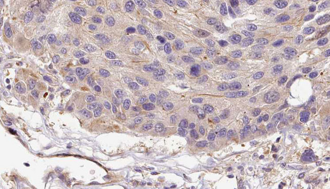 SERPINF2 / Alpha-2-Antiplasmin Antibody - 1:100 staining human Melanoma tissue by IHC-P. The sample was formaldehyde fixed and a heat mediated antigen retrieval step in citrate buffer was performed. The sample was then blocked and incubated with the antibody for 1.5 hours at 22°C. An HRP conjugated goat anti-rabbit antibody was used as the secondary.