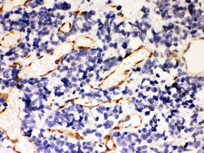 SERPINH1 / HSP47 Antibody - Hsp47 antibody IHC-paraffin: Human Lung Cancer Tissue.