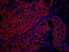 SET / TAF-I Antibody - Detection of Human SET by Immunohistochemistry. Sample: FFPE section of human prostate carcinoma. Antibody: Affinity purified rabbit anti-SET used at a dilution of 1:100. Detection: Red-fluorescent Goat anti-Rabbit IgG-heavy and light chain cross-adsorbed Antibody DyLight 594 Conjugated (A120-601D4) used at a dilution of 1:100.