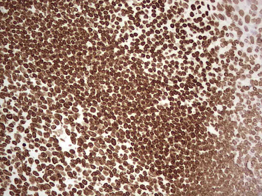 SETD1A / SET1 Antibody - Immunohistochemical staining of paraffin-embedded Human tonsil within the normal limits using anti-SETD1A mouse monoclonal antibody. (Heat-induced epitope retrieval by 1 mM EDTA in 10mM Tris, pH8.5, 120C for 3min,