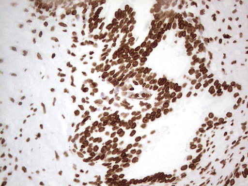 SETD1A / SET1 Antibody - IHC of paraffin-embedded Human prostate tissue using anti-SETD1A mouse monoclonal antibody. (Heat-induced epitope retrieval by 1 mM EDTA in 10mM Tris, pH8.5, 120°C for 3min).