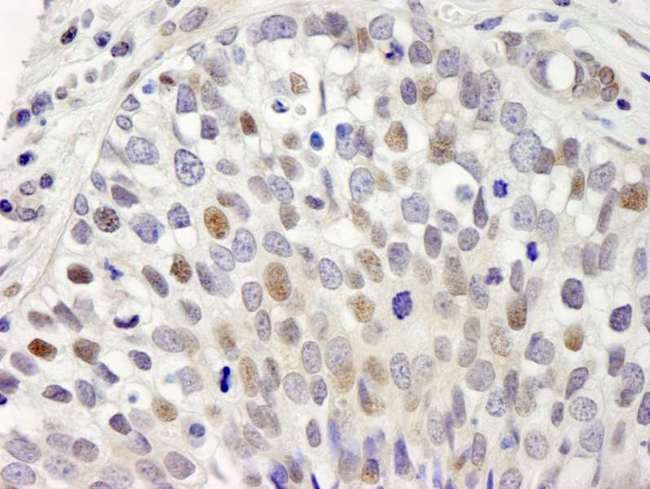 SETD1A / SET1 Antibody - Detection of Human hSET1 by Immunohistochemistry. Sample: FFPE section of human breast adenocarcinoma. Antibody: Affinity purified rabbit anti-hSET1 used at a dilution of 1:250.
