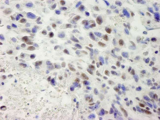 SETD1A / SET1 Antibody - Detection of Mouse hSET1 by Immunohistochemistry. Sample: FFPE section of mouse squamous cell carcinoma. Antibody: Affinity purified rabbit anti-hSET1 used at a dilution of 1:250.
