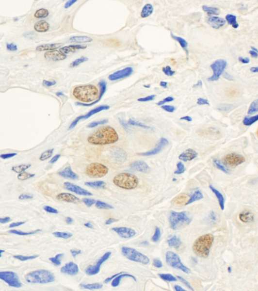 SETD1A / SET1 Antibody - Detection of Human hSET1 by Immunohistochemistry. Sample: FFPE section of human breast carcinoma. Antibody: Affinity purified rabbit anti-hSET1 used at a dilution of 1:1000 (1 ug/ml). Detection: DAB.