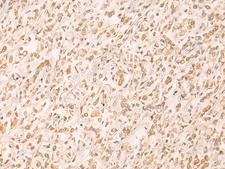 SETD1A / SET1 Antibody - Immunohistochemistry of paraffin-embedded Human gastric cancer tissue  using SETD1A Polyclonal Antibody at dilution of 1:25(×200)