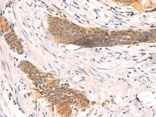 SETD1A / SET1 Antibody - Immunohistochemistry of paraffin-embedded Human esophagus cancer tissue  using SETD1A Polyclonal Antibody at dilution of 1:40(×200)
