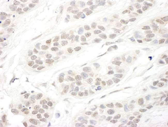 SETD1B / SET1B Antibody - Detection of Human hSET1B by Immunohistochemistry. Sample: FFPE section of human breast carcinoma. Antibody: Affinity purified rabbit anti-hSET1B used at a dilution of 1:1000 (1 Detection: DAB.