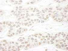 SETD1B / SET1B Antibody - Detection of Human hSET1B by Immunohistochemistry. Sample: FFPE section of human breast carcinoma. Antibody: Affinity purified rabbit anti-hSET1B used at a dilution of 1:250.