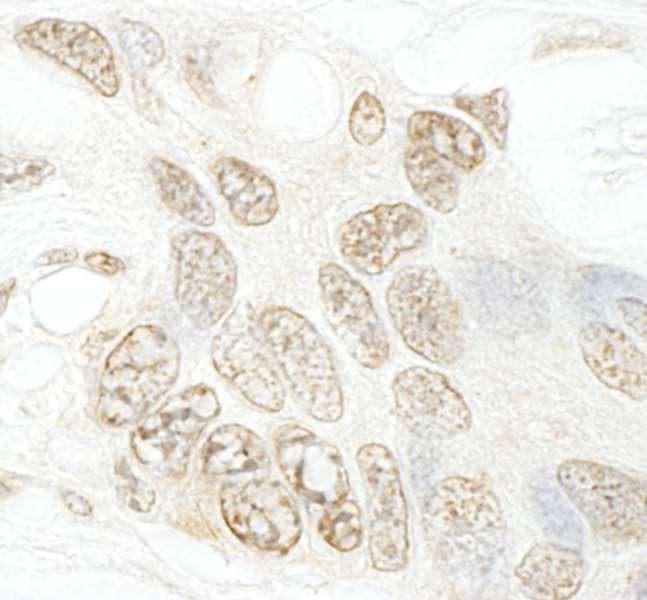 SETD1B / SET1B Antibody - Detection of Human hSET1B by Immunohistochemistry. Sample: FFPE section of human ovarian carcinoma. Antibody: Affinity purified rabbit anti-hSET1B used at a dilution of 1:250.